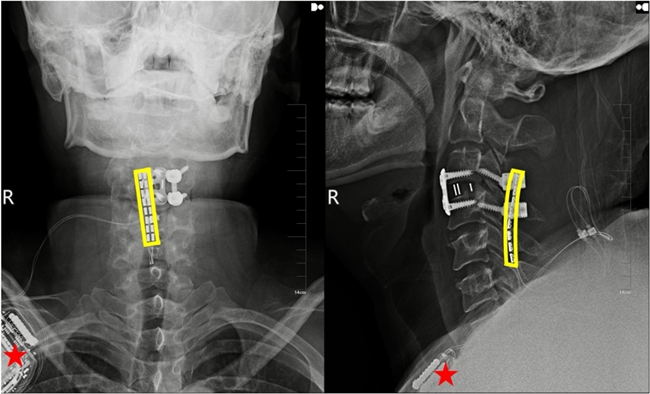 植入術(shù)后X線顯示,黃色方框?yàn)殡姌O位置,星號(hào)為皮下脈沖發(fā)射器位置。