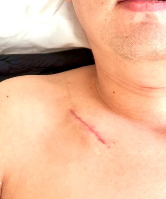 術(shù)后皮下脈沖發(fā)射器植入位置的微創(chuàng)切口。